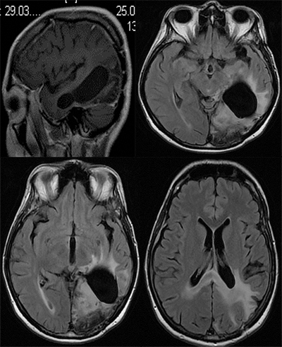 МРТ мозга спустя 10 месяцев
