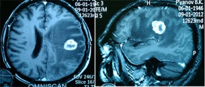 Метастаз рака легкого МРТ до операции