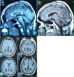 МРТ-исследование мозга больного