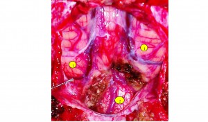 Интраоперационная картина после выполненной субпиальной микрохирургической резекции опушенных миндалин мозжечка с декомпрессией большой цистерны, продолговатого мозга и верхнешейного отдела спинного мозга. Выход из 4-го желудочка свободен. Видны полушария мозжечка (1), верхнешейный отдел спинного мозга (2).