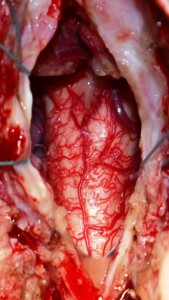 Интраоперационная картина после выполненной субокципитальной рекраниотомии,  удаления рубцовой ткани, частичной аркотомии 2-го шейного позвонка  и разведения краев твердой мозговой оболочки краниовертебрального перехода.  Видны увеличенные в размерах и опушенные миндалики мозжечка (1), верхнешейный отдел спинного мозга (2). Выход из 4-го желудочка заблокирован.