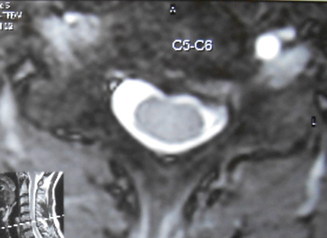 Грыжа шейного отдела с5 с7