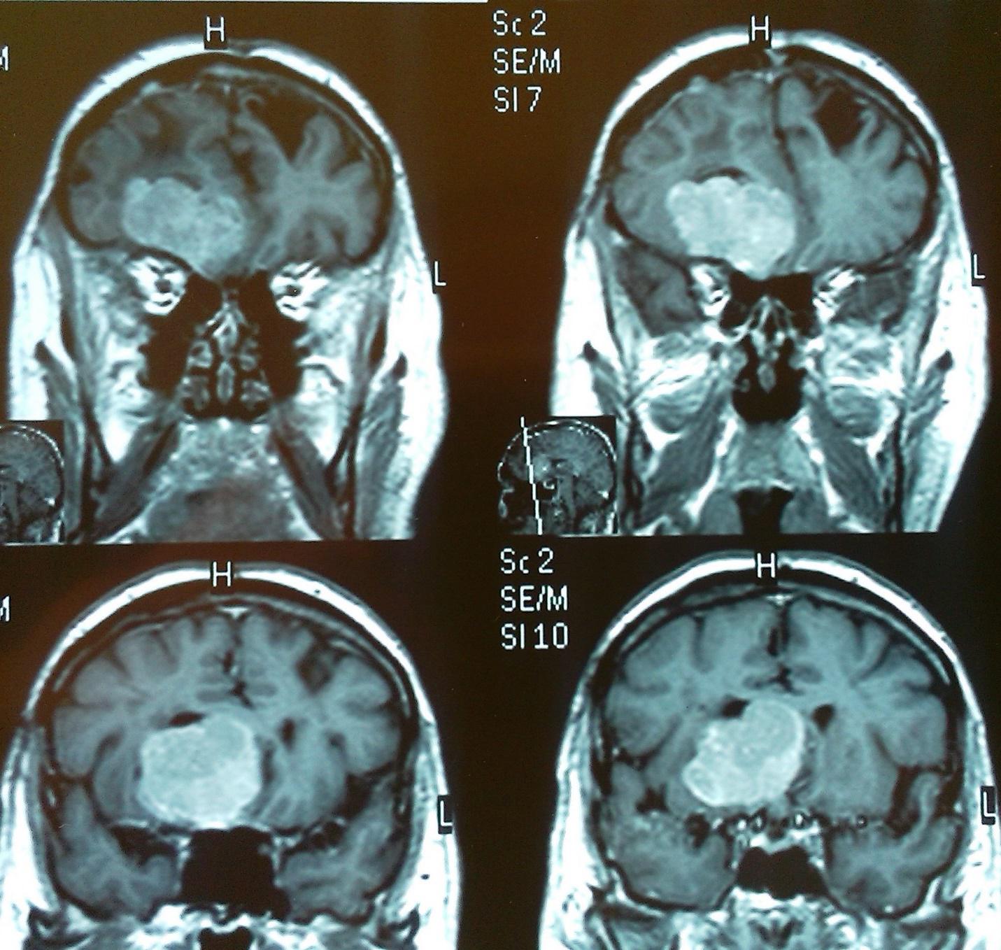После операции менингиомы головного мозга. Менингиома головного опухоль. Менингиома основания черепа мрт. Менингиома лобной кости кт.